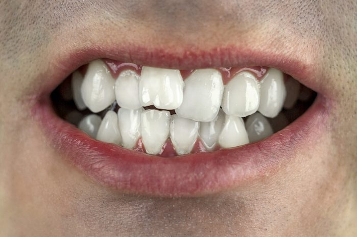 treat crooked teeth in denton, texas