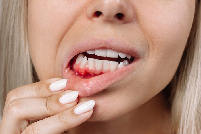 treat gum disease and bleeding gums in denton, texas